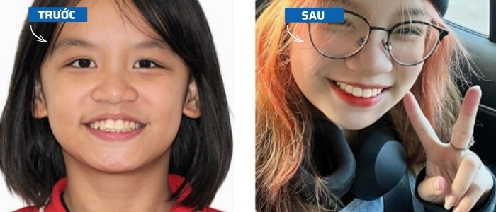 Hình ảnh trước và sau khi niềng răng ở trẻ em