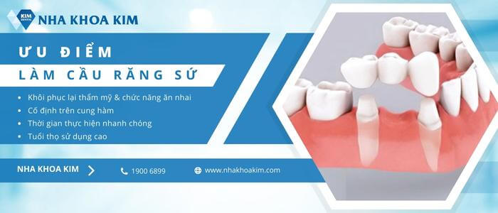 Ưu điểm của cầu răng sứ