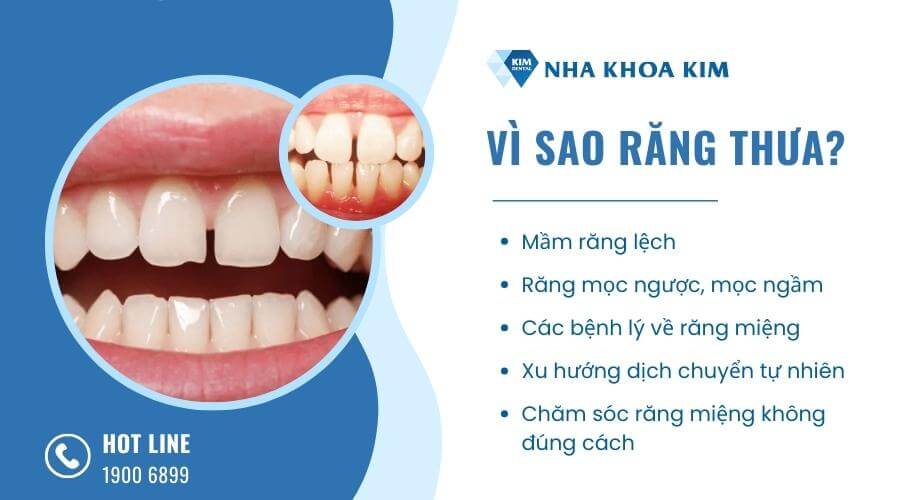 Vì sao răng bị thưa?