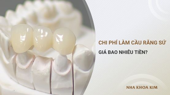 Tổng chi phí làm cầu răng sứ giá bao nhiêu?