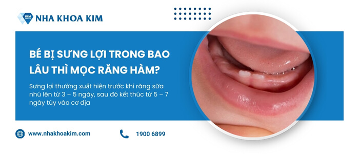 Bé bị sưng lợi trong bao lâu thì mọc răng hàm?