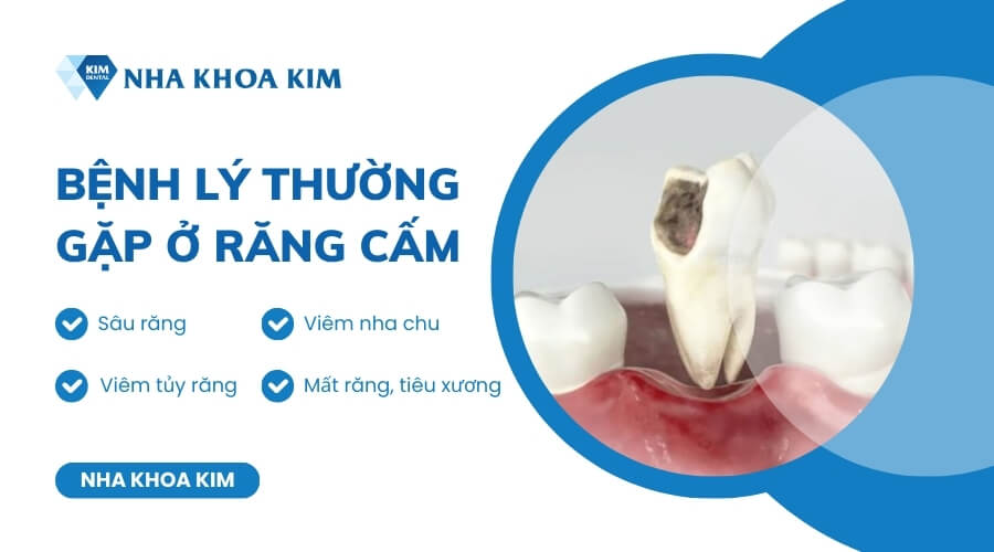 Những bệnh lý thường gặp ở răng cấm