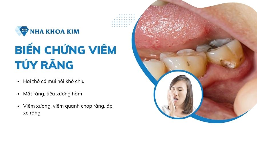 Những biến chứng viêm tủy răng