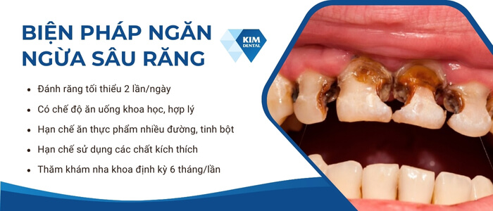 Biện pháp ngăn ngừa sâu răng