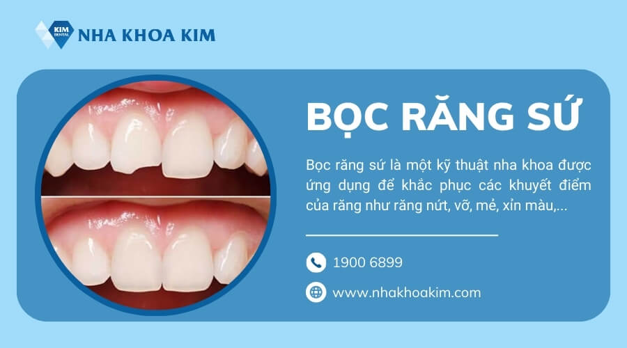 Bọc răng sứ là gì?