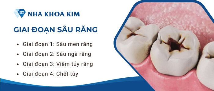 Các giai đoạn sâu răng