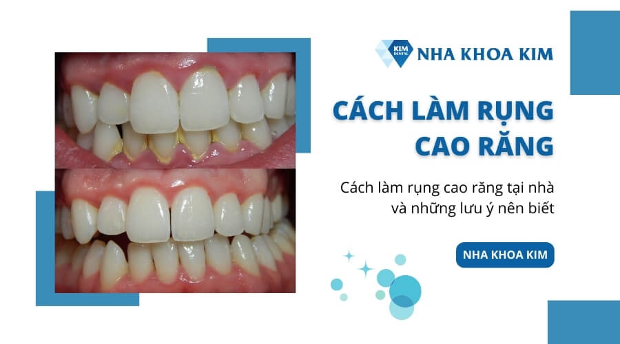 Cách làm rụng cao răng tại nhà và những lưu ý nên biết