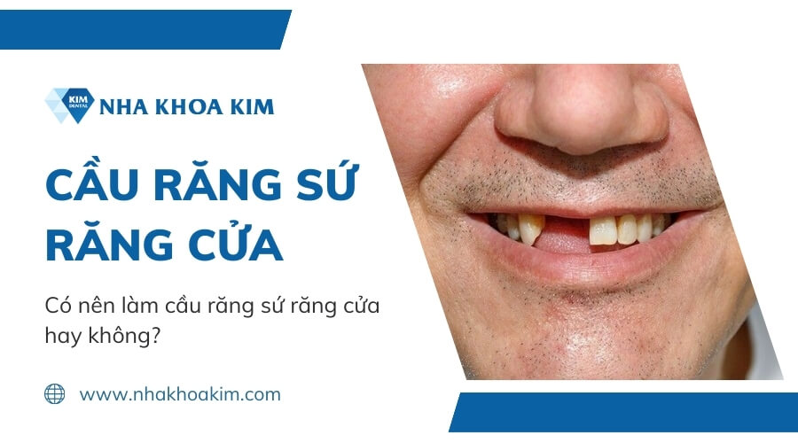 Có nên làm cầu răng sứ răng cửa hay không?