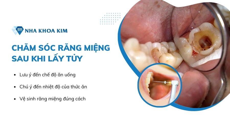 Cách chăm sóc răng miệng sau khi lấy tủy
