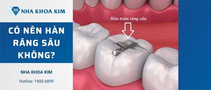 Có nên hàn răng sâu không?