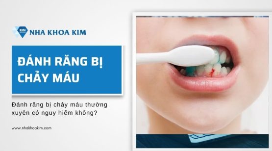 Đánh răng bị chảy máu thường xuyên có nguy hiểm không?