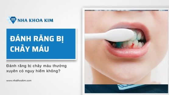 Đánh răng bị chảy máu thường xuyên có nguy hiểm không?