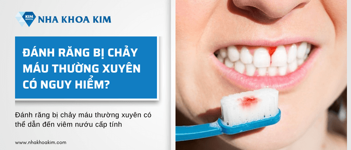 Đánh răng bị chảy máu thường xuyên có nguy hiểm không?