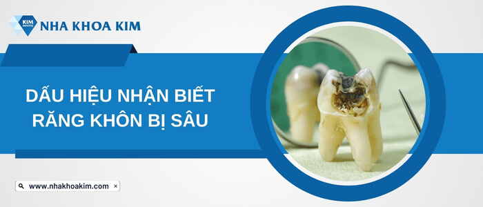 Dấu hiệu nhận biết sâu răng khôn (răng số 8) 