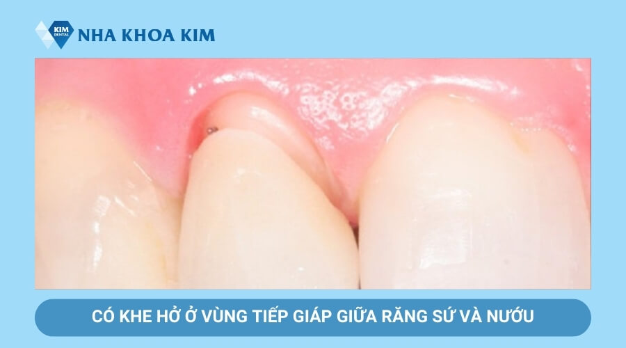 Dấu hiệu hỡ kẽ chân răng sứ