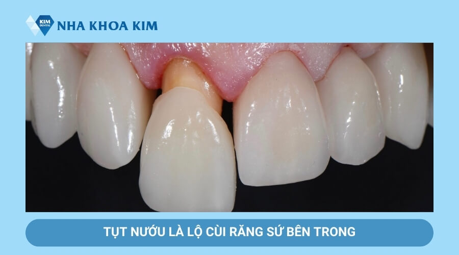 Dấu hiêu răng sứ bị hở cổ chân