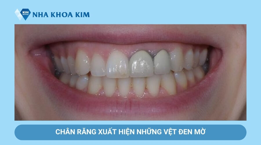 Chân răng sứ bị hở có những vệt đen mờ