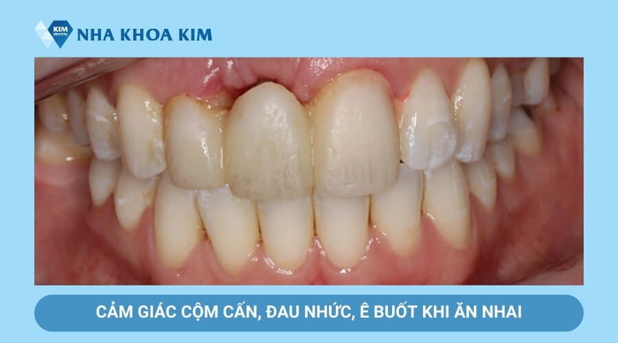 Cảm giác cộm cấn, đau nhức khi chân răng sứ bị hở