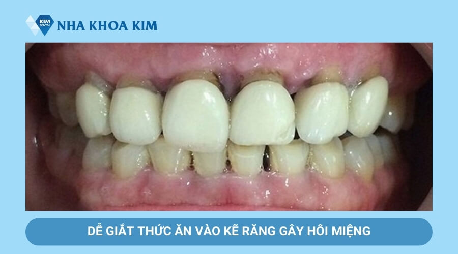 Hôi miệng cho chân răng sứ bị hở