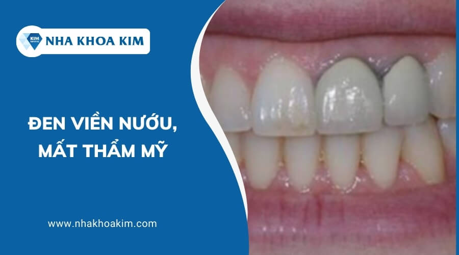 Bọc răng sứ kém chất lượng gây ra tình trạng đen viền nướu