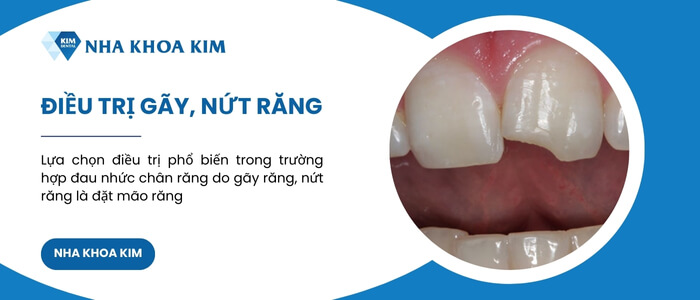 Điều trị gãy và nứt răng