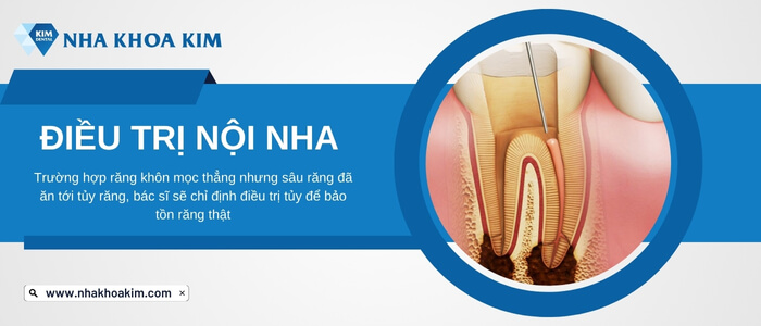 Điều trị nội nha răng khôn bị sâu