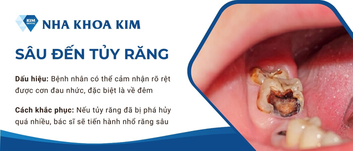 Mức độ 3: Sâu đến tủy răng 