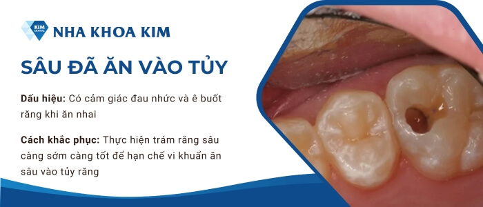 Mức độ 2: Sâu răng đã ăn vào tủy 