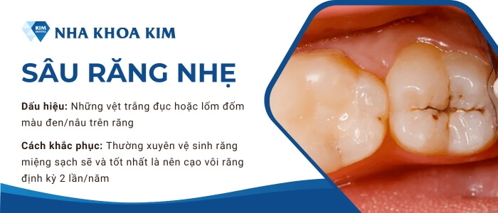 Mức độ 1: Sâu răng nhẹ