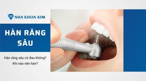 Hàn răng sâu: Thông tin cần biết về hàn răng sâu