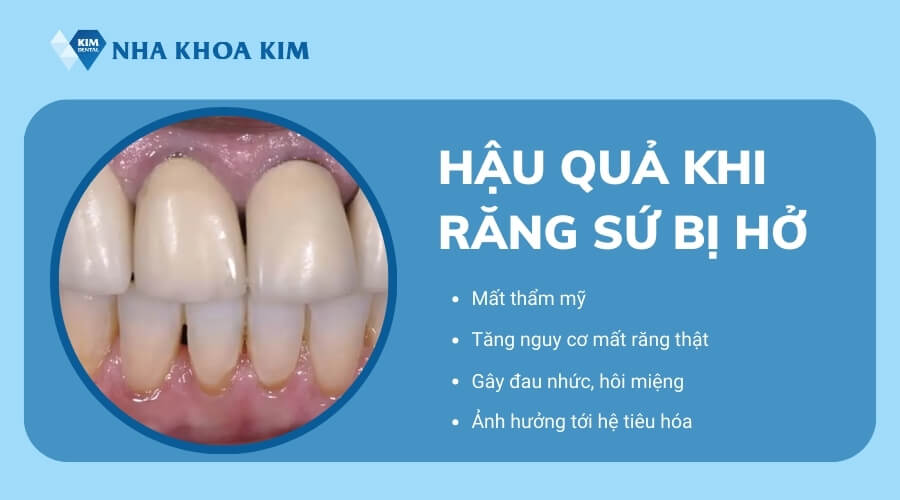 Răng sứ bị hở có sao không?