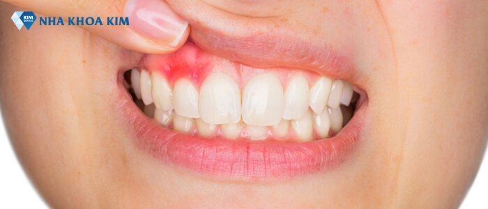 Hình ảnh viêm nướu răng giúp sớm nhận biết và điều trị