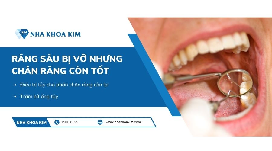 Cách khắc phục răng sâu bị vỡ nhưng còn chân răng tốt