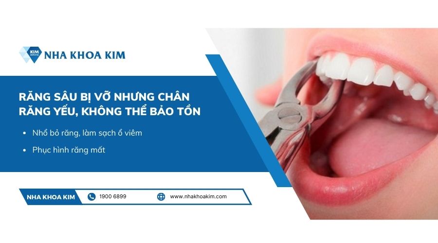 Cách khắc phục răng sâu bị vỡ không thể bảo tồn được