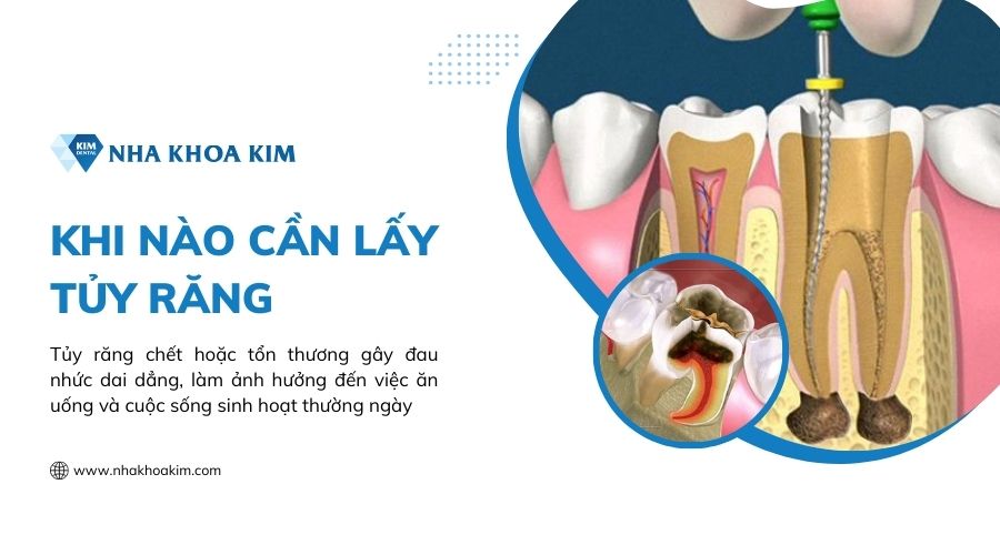 Khi nào cần lấy tủy răng?