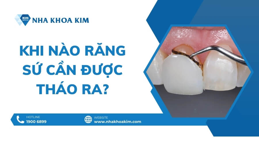 Khi nào răng sứ cần được tháo ra?