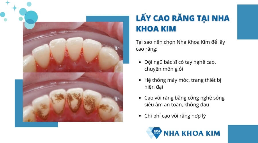 Lấy cao răng nhanh chóng, hiệu quả tại Nha Khoa Kim