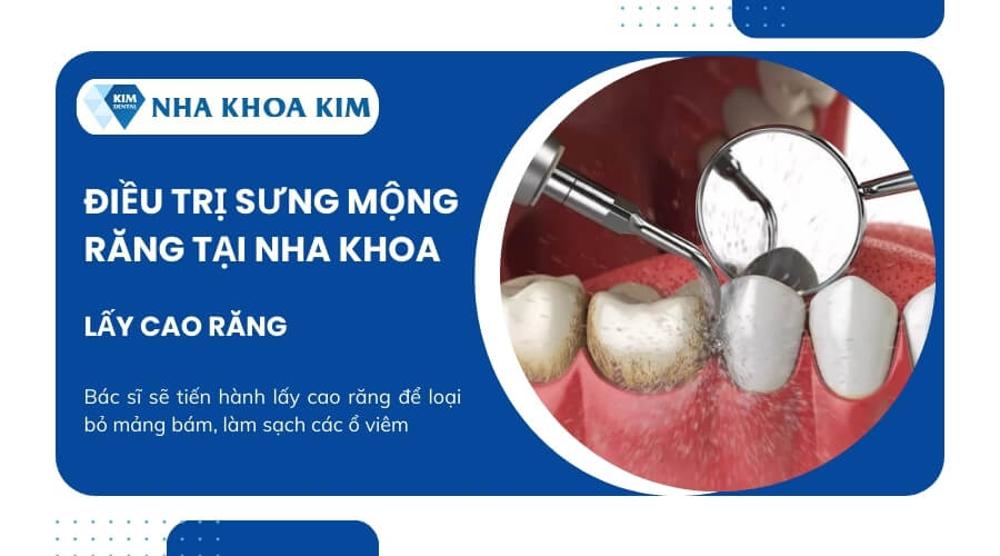 Cách chữa sưng mộng răng tại nha khoa