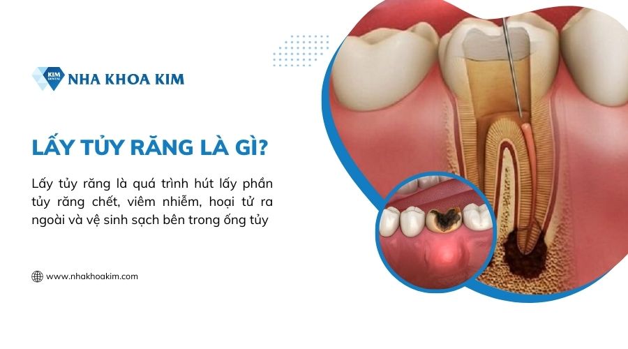 Lấy tủy răng là gì?