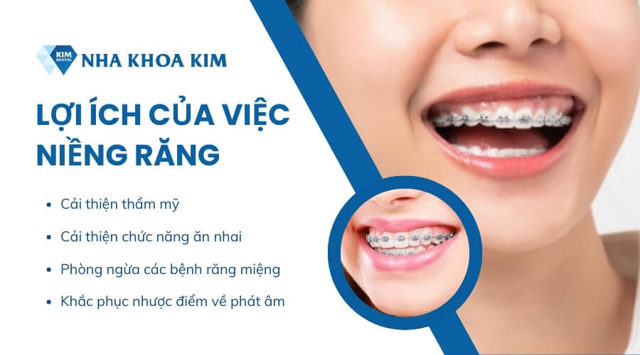 Lợi ích của việc niềng răng