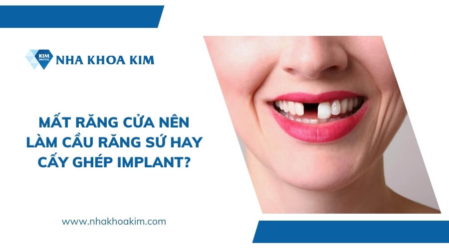 Mất răng cửa nên làm cầu răng sứ hay cấy ghép Implant?