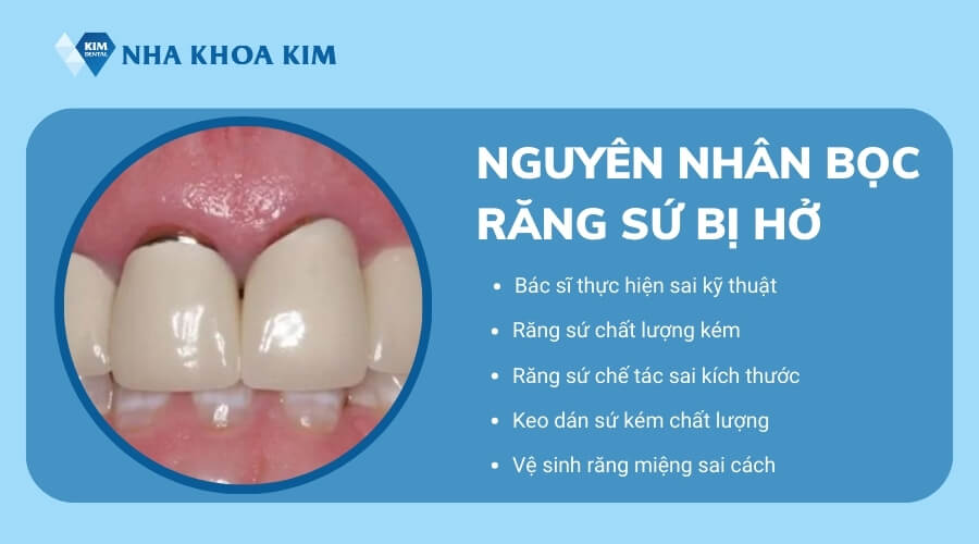 Nguyên nhân bọc răng sứ bị hở