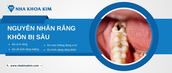 Nguyên nhân răng khôn bị sâu