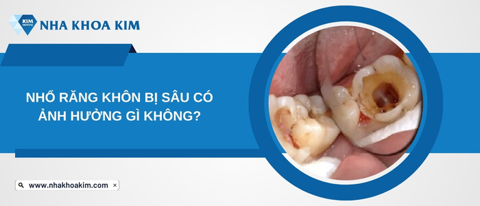 Nhổ răng khôn bị sâu có ảnh hưởng gì không?