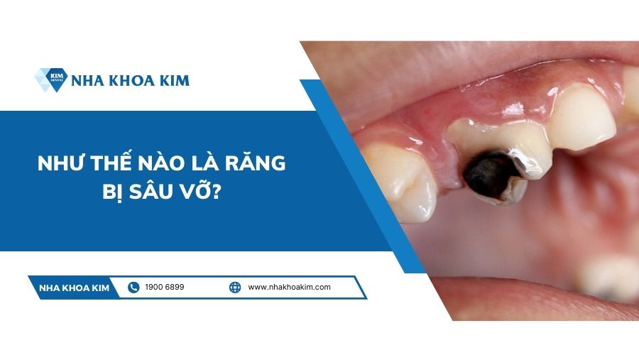 Như thế nào là răng bị sâu vỡ?