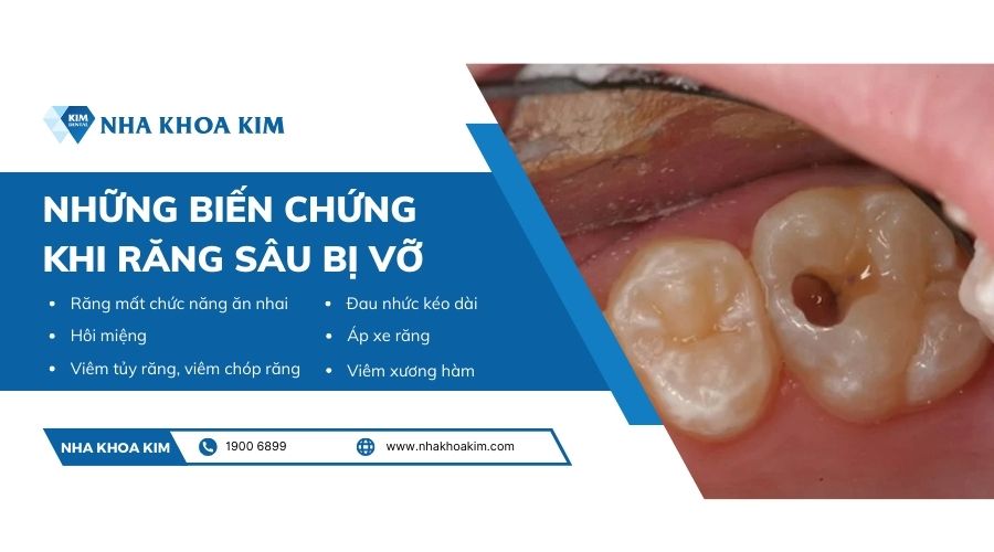 Những biến chứng khi răng sâu bị vỡ