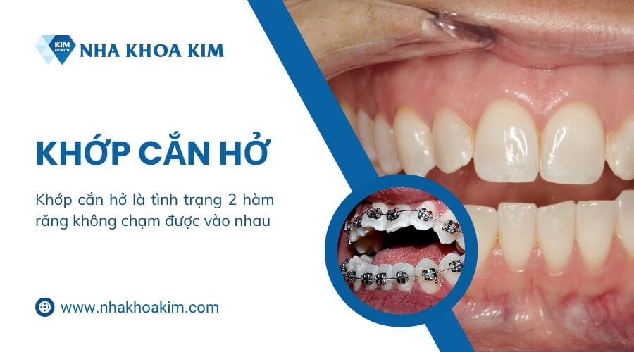 Niềng răng khớp cắn hở