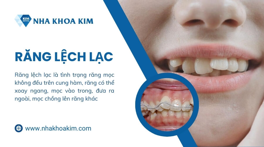 Niềng răng lệch lạc