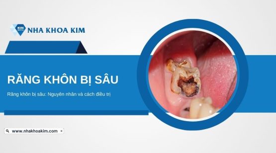 Răng khôn bị sâu: Nguyên nhân và cách điều trị