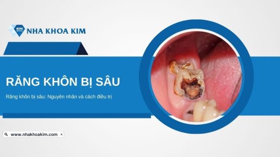 Răng khôn bị sâu: Nguyên nhân và cách điều trị